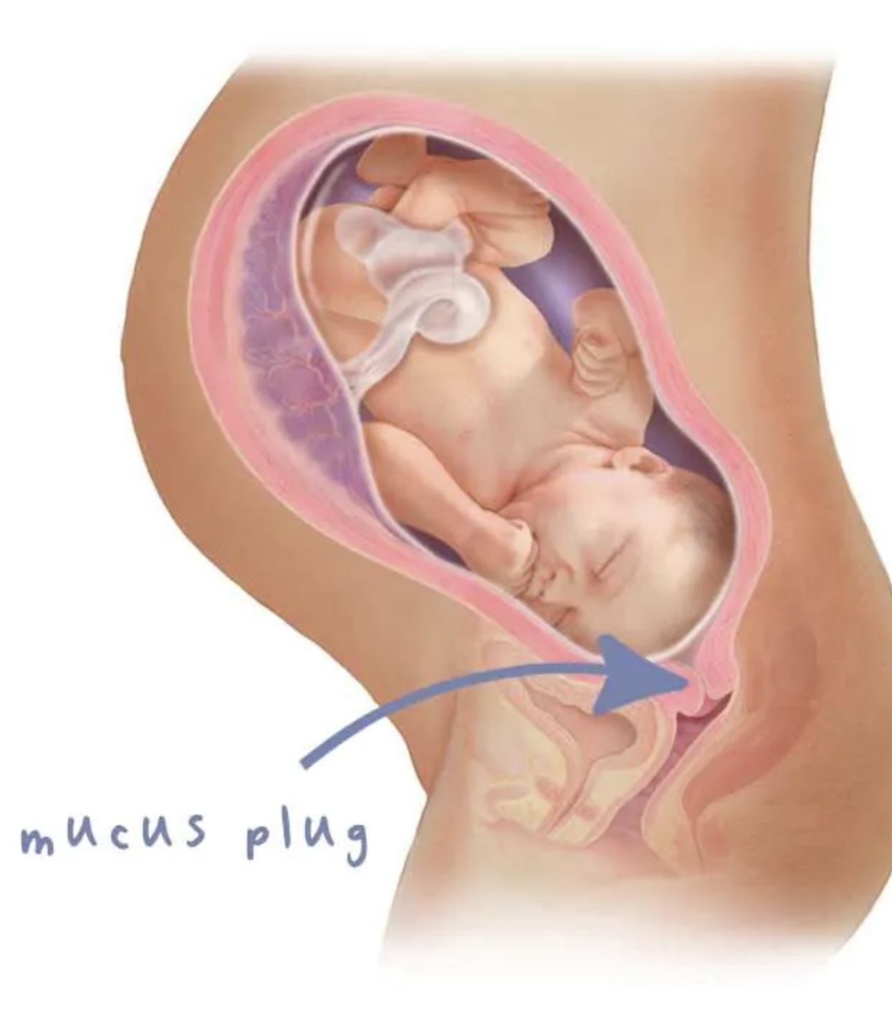 Understanding Mucus Plug 3