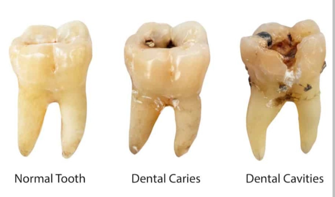 Visual Appearance of a Cavity 1