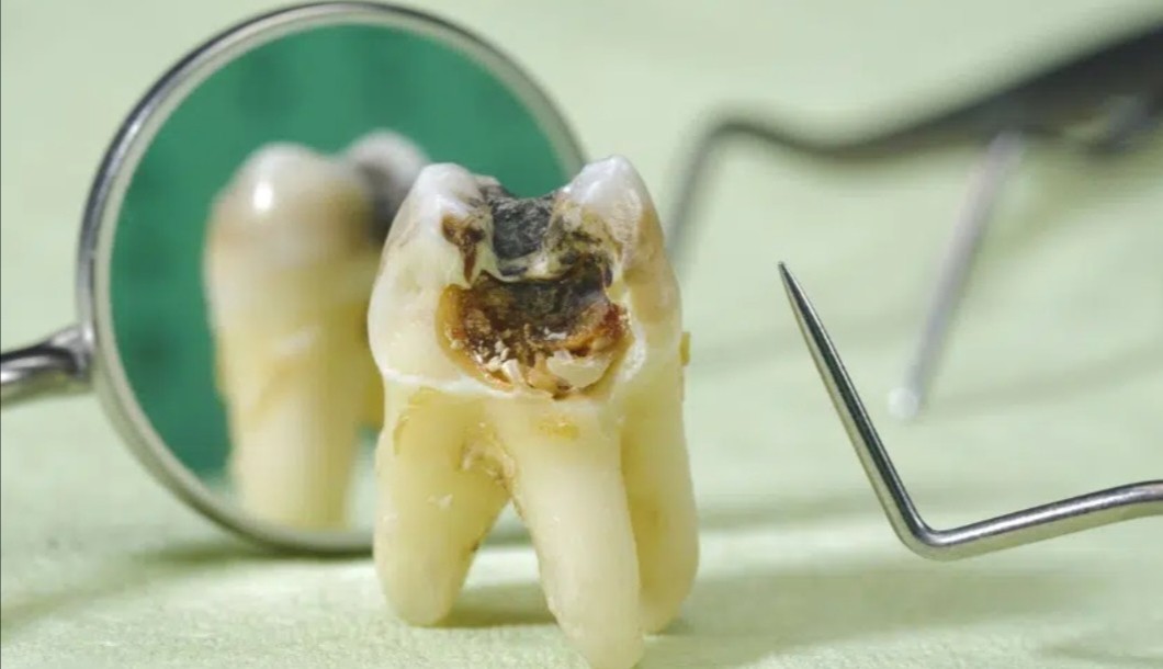 Visual Appearance of a Cavity 2